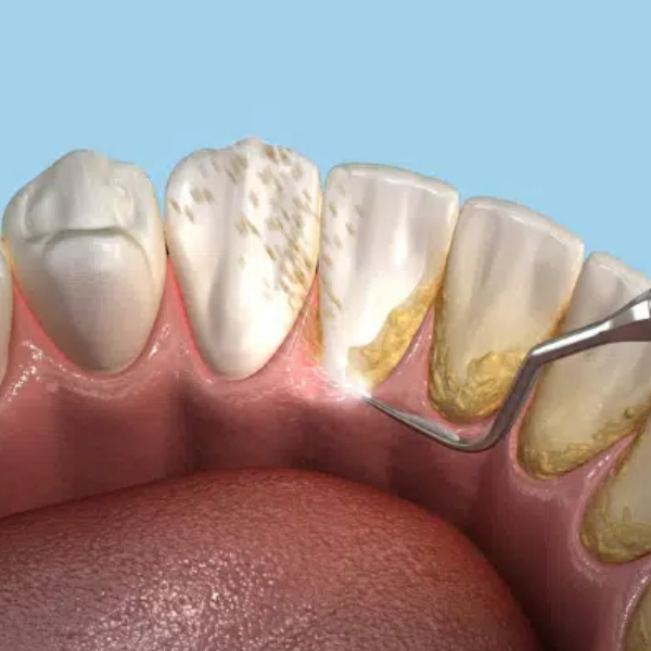 the-effect-of-dental-scaling-on-the-improvement-of-bad-breath2