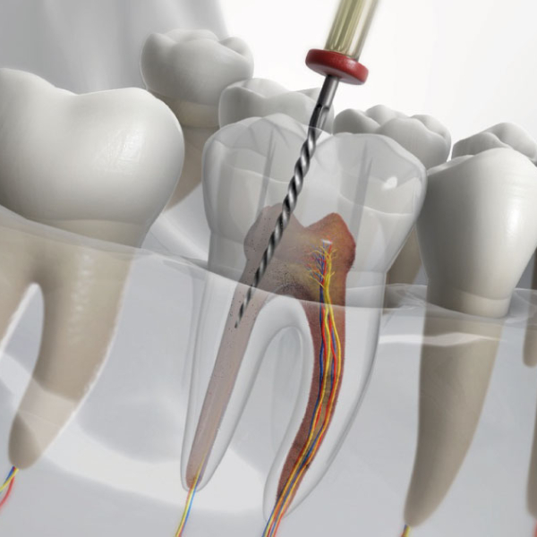 the-reason-for-tooth-color-change-after-nerve-extraction2