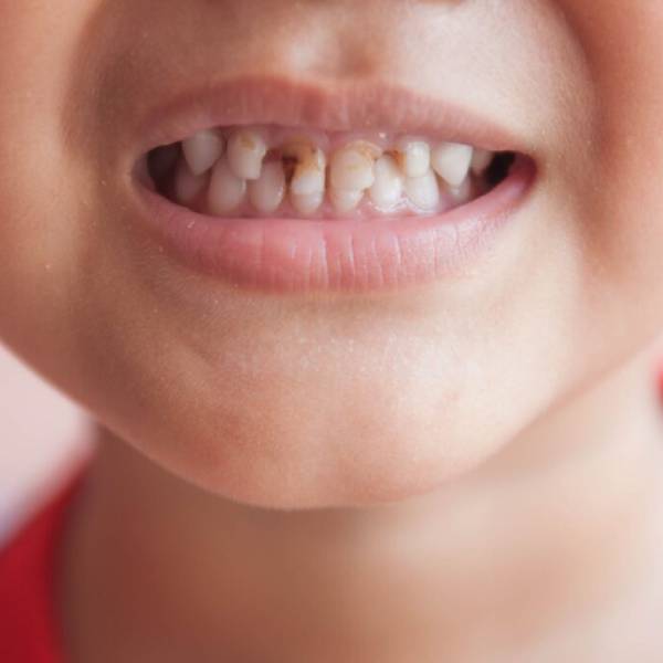 tooth-decay-in-children-causes-prevention-and-treatment