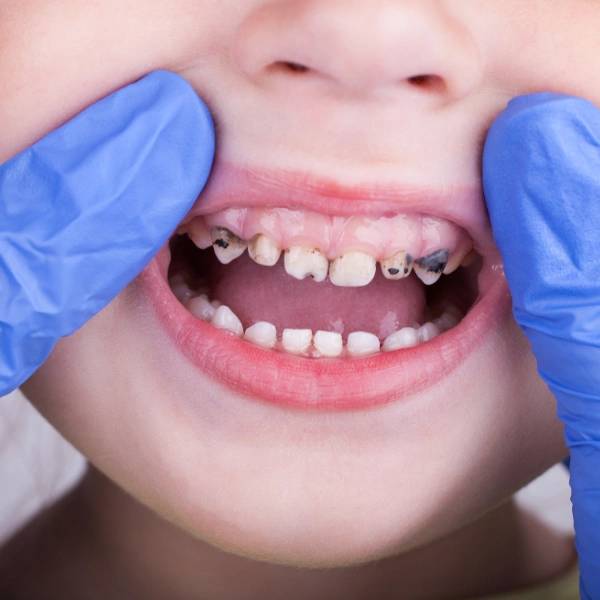 tooth-decay-in-children-causes-prevention-and-treatment2