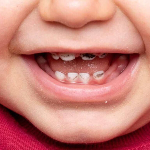 علت پوسیدگی و سیاه شدن دندان کودکان