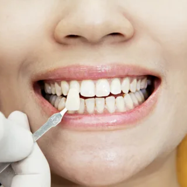 types-of-dental-veneers2