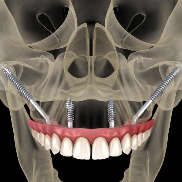 zygomatic-implant