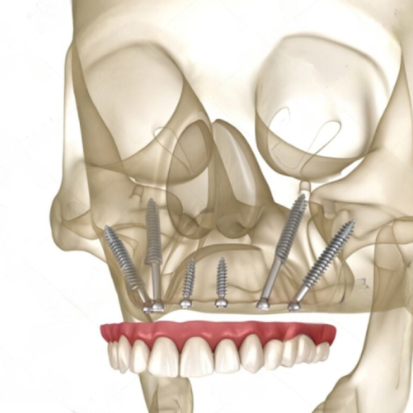 zygomatic-implant3