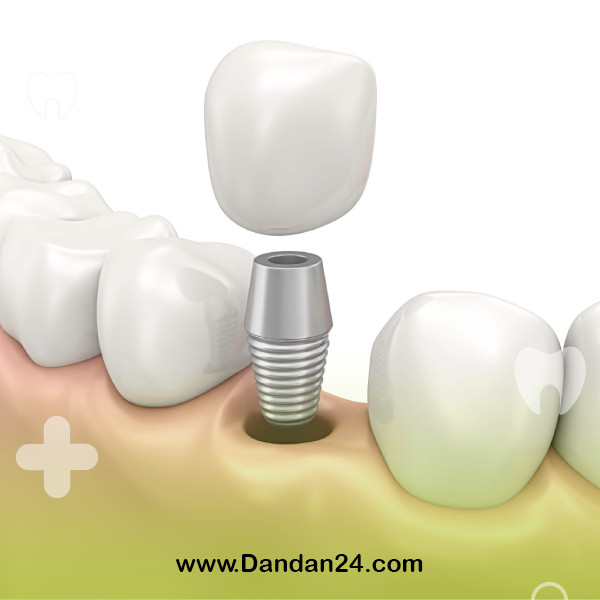age-limit-for-dental-implant-placement