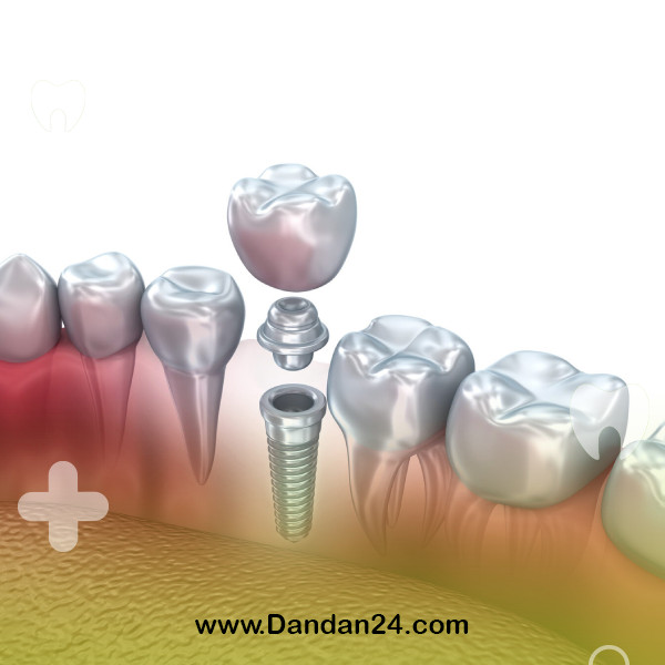 bone-grafting-for-implants