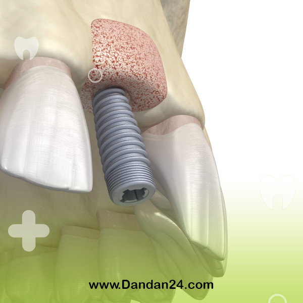 bone-grafting-for-implants