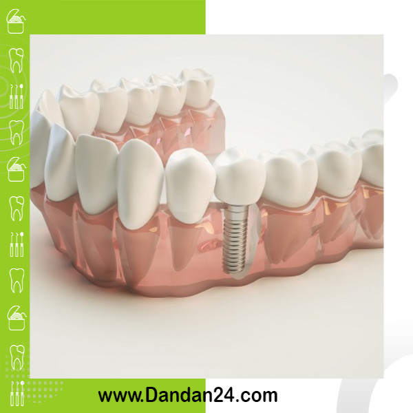 مراقبت های بعد از نصب ایمپلنت دندان: راهنمای کامل برای بیماران