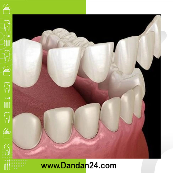 common-mistakes-patients-make-after-dental-lamination