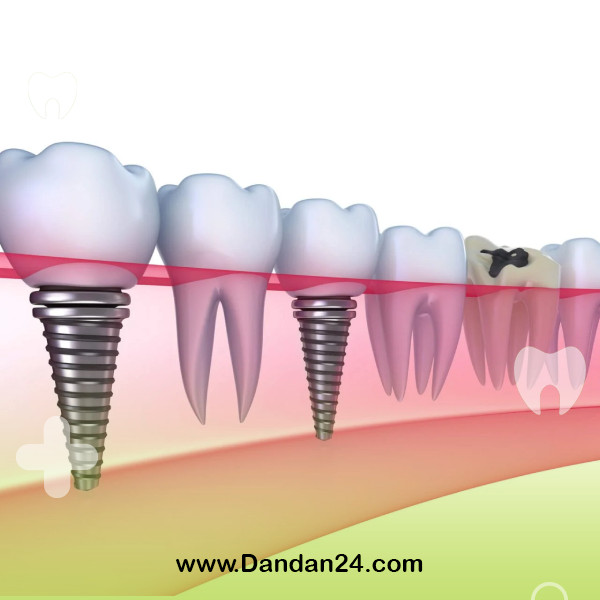 comparison of dental implant and dental bridge