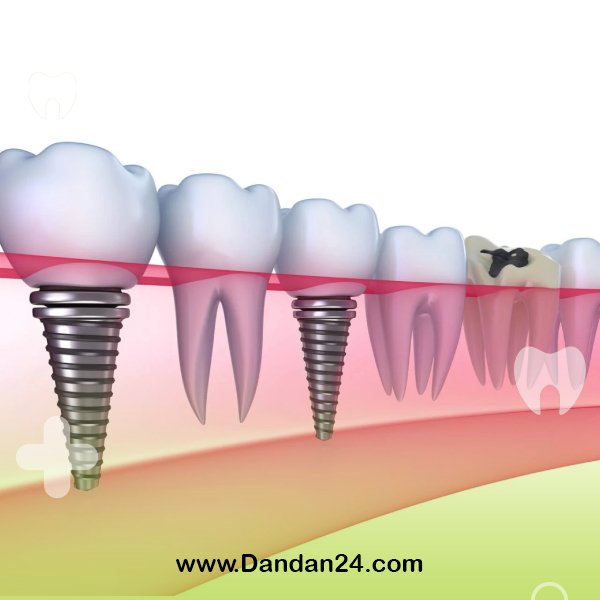 comparison of dental implant and dental bridge
