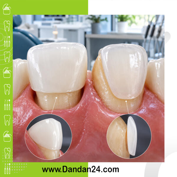 crown-vs-veneer