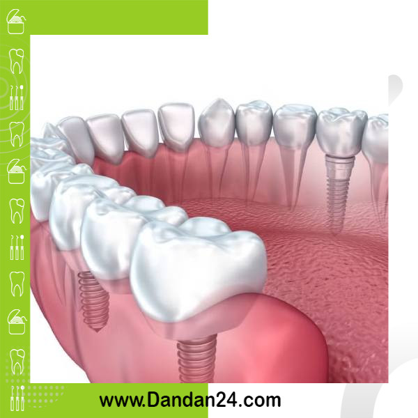 dental-implant-cost-in-1404