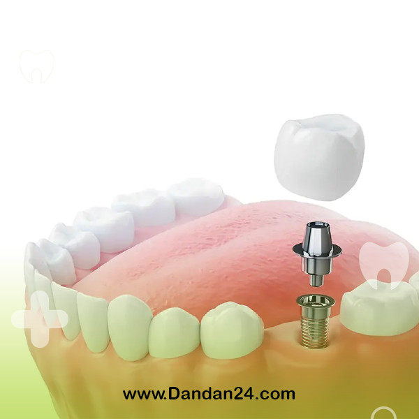 dental-implant-screw-breakage2