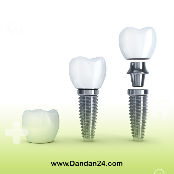 dental-implant-screw-breakage