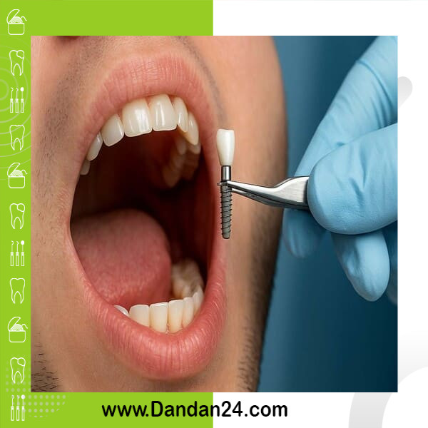 dental-implant-step-by-step-cost-best-brands