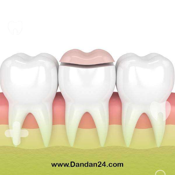 dental-inlays-and-onlays2