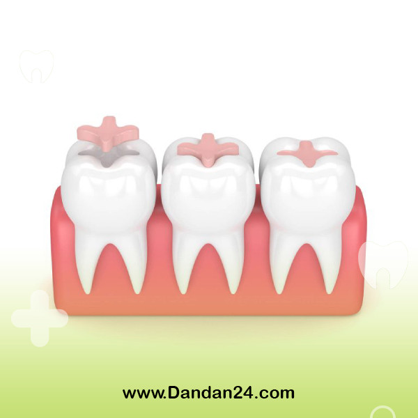 dental-inlays-and-onlays