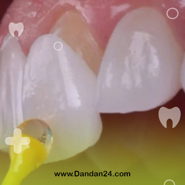 dental-laminate-care2