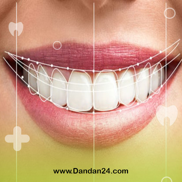 dental-laminate-care