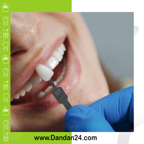 لمینت دندان یا کامپوزیت؟ مقایسه کامل + قیمت 1404 | دندان 24