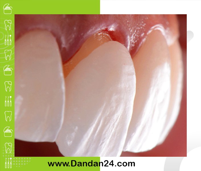 لمینت دندان یا روکش؟ کدام یک برای شما مناسب تر است؟