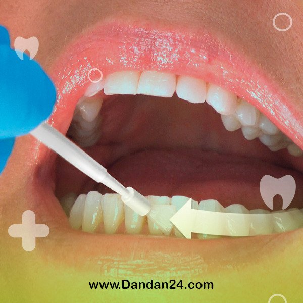 Dental varnish or fluoride therapy