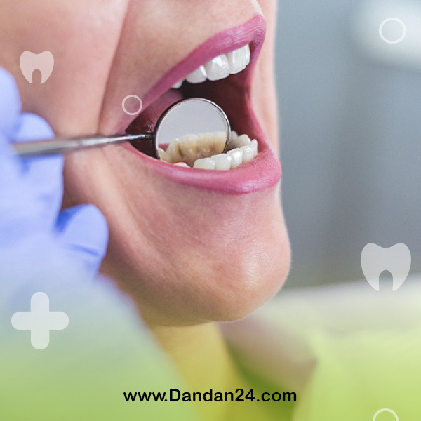does-scaling-thin-the-tooth