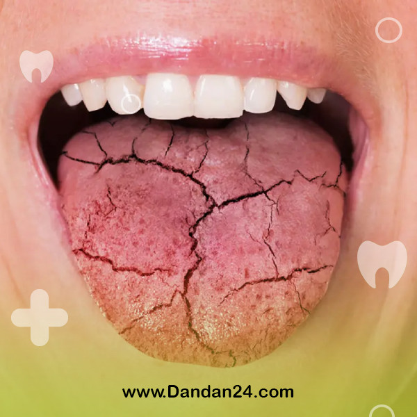 dry-mouth-causes-and-treatment-methods