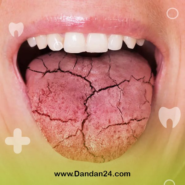 dry-mouth-causes-and-treatment-methods