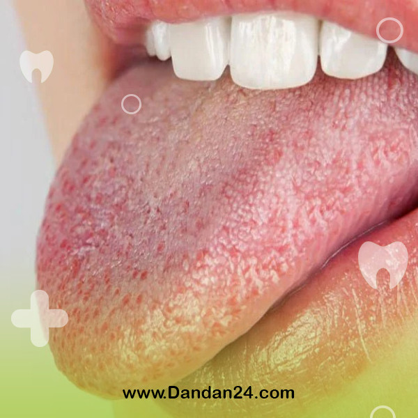 dry-mouth-causes-and-treatment-methods3