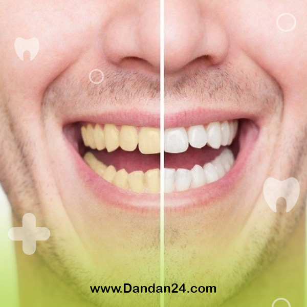 exfoliation and teeth whitening
