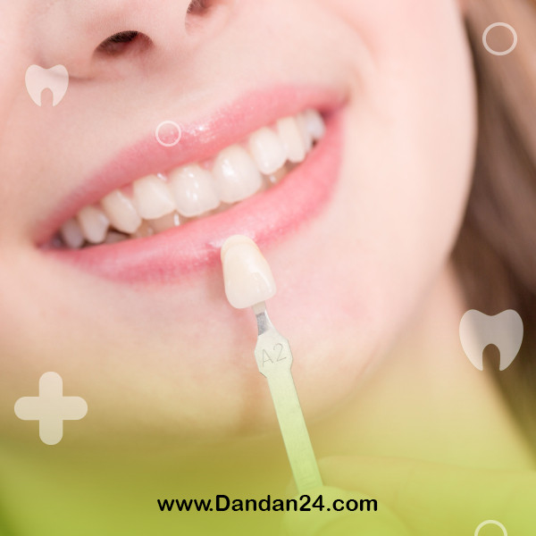 factors-affecting-the-lifespan-of-dental-laminate