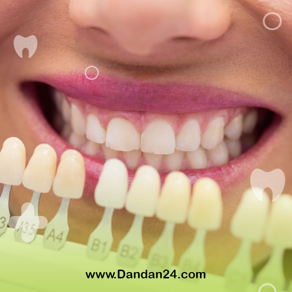 factors-affecting-the-lifespan-of-dental-laminate2