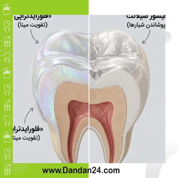 fluoride-vs-fissure-sealant-kids