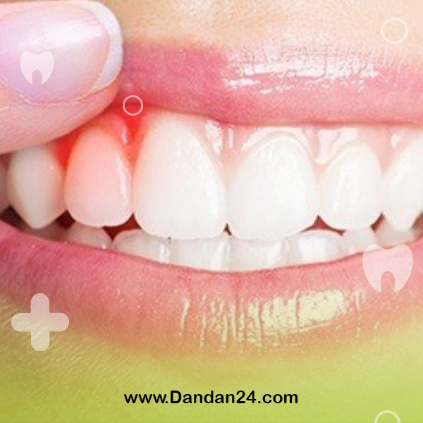 gum-biopsy2