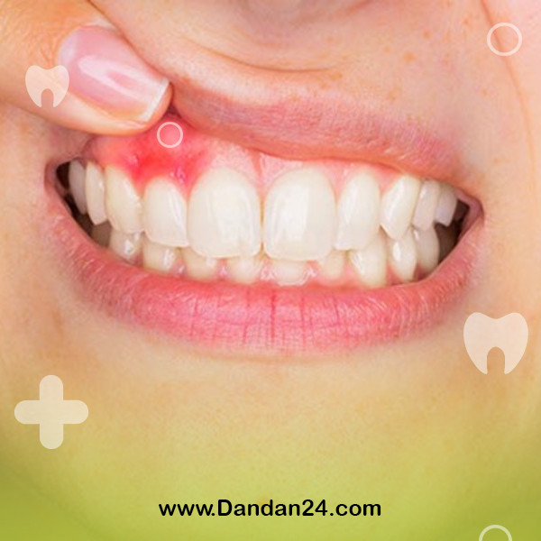 gum-biopsy