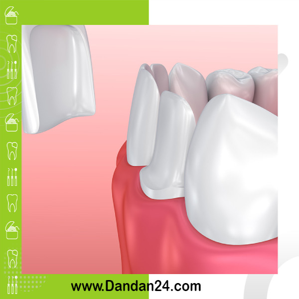 کامپوزیت دندان چگونه است؟