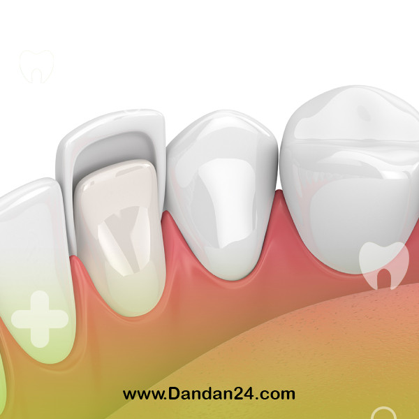how-is-dental-composite2