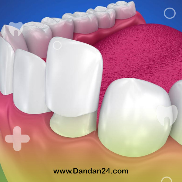 how-is-dental-composite