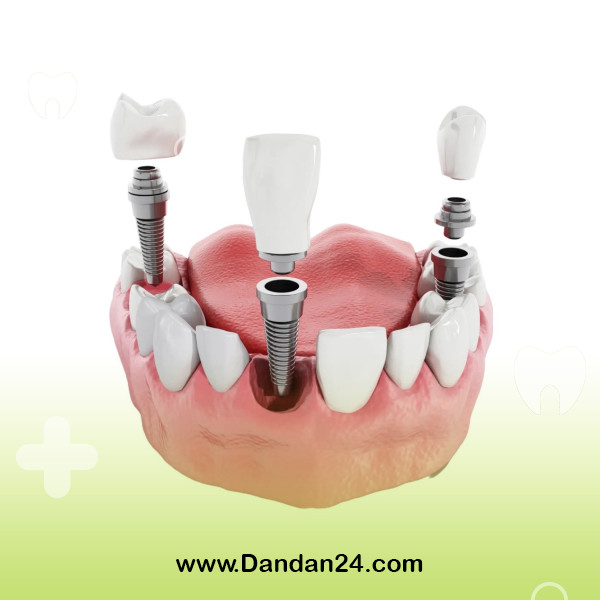 how-long-after-tooth-extraction-should-be-implanted