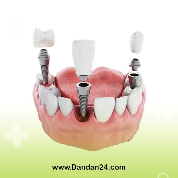how-long-after-tooth-extraction-should-be-implanted