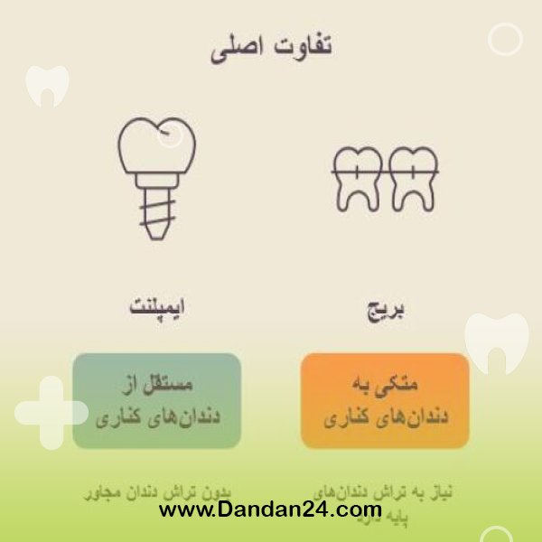 ایمپلنت یا بریج