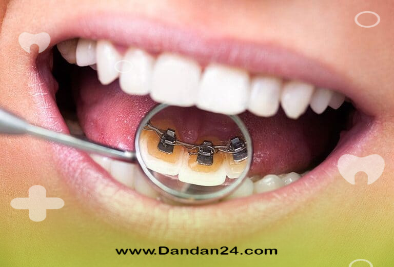مزایای ارتودنسی نامرئی و پنهان