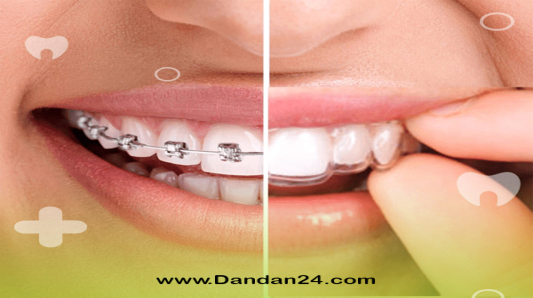 ارتودنسی نامرئی