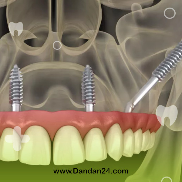 jaw-bone-grafting-for-dental-implants2