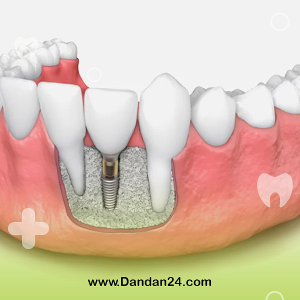 jaw-bone-grafting-for-dental-implants