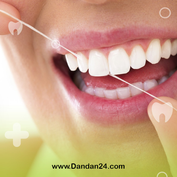 laminated-tooth-scaling