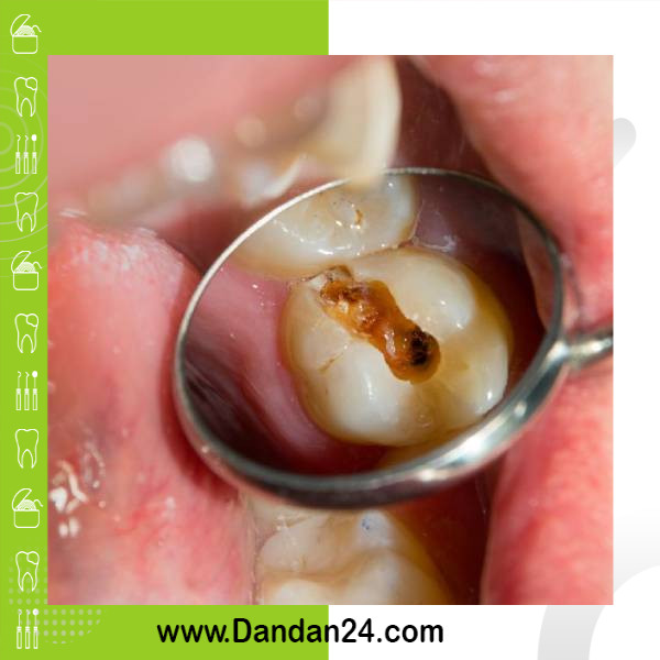 methods-for-preventing-tooth-decay
