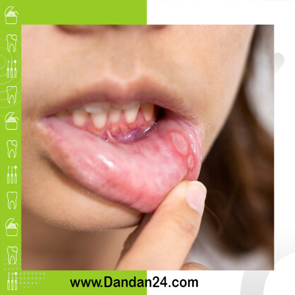 ارزیابی عوامل خطر ابتلا به سرطان دهان